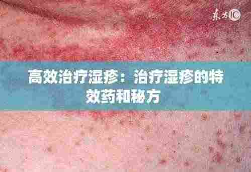 高效治疗湿疹：治疗湿疹的特效药和秘方 