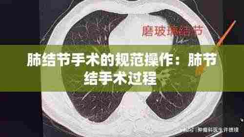肺结节手术的规范操作:肺节结手术过程
