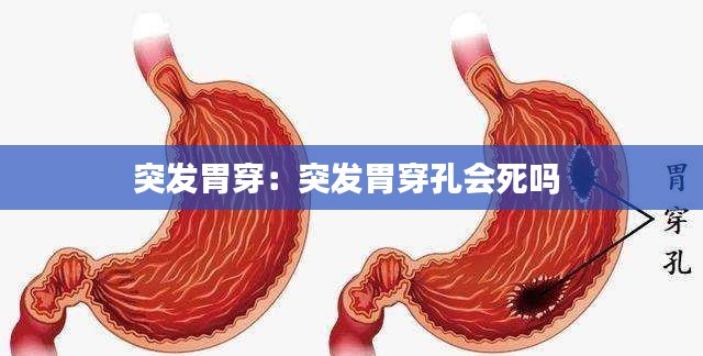 突发胃穿：突发胃穿孔会死吗 